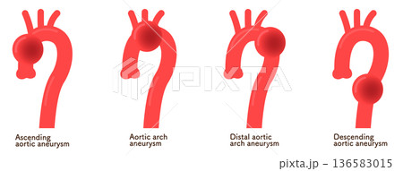 大動脈瘤のイラスト　Illustration of an aortic aneurysm 136583015