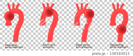 大動脈瘤のイラスト　Illustration of an aortic aneurysm 136583015