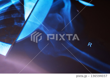 Assessment of prosthetic positioning and bone health during postoperative examination process Assessment of prosthetic positioning and bone health during postoperative examination process 136594037