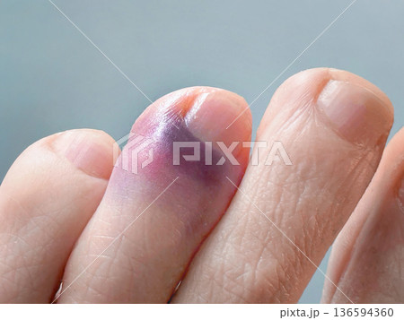 Toe with bruise and hematoma closeup showing purple discoloration and swelling on skin surface. Concept of Injury of foot, broken toes, phalange fracture, bruise and medical care Toe with bruise and hematoma closeup showing purple discoloration and swelling on skin surface. Concept of Injury of foot, broken toes, phalange fracture, bruise and medical care 136594360