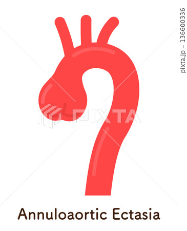 大動脈弁輪拡張症のイラスト annuloaortic ectasia(AAE) 大動脈弁輪拡張症のイラスト annuloaortic ectasia(AAE) 136600336