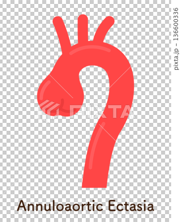 大動脈弁輪拡張症のイラスト annuloaortic ectasia(AAE) 大動脈弁輪拡張症のイラスト annuloaortic ectasia(AAE) 136600336