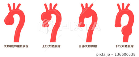 大動脈弁輪拡張症と大動脈瘤 annuloaortic ectasia&aortic aneurysm 136600339