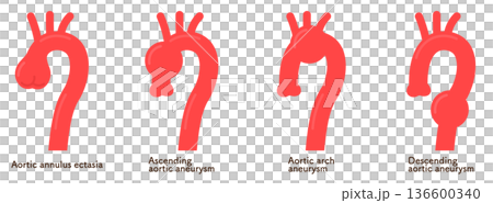 Aortic Annular Ectoses and Aortic Aneurysms 136600340