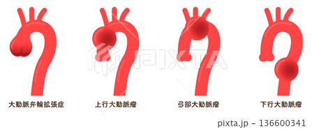 大動脈弁輪拡張症と大動脈瘤 annuloaortic ectasia&aortic aneurysm 136600341