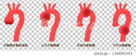 大動脈弁輪拡張症と大動脈瘤 annuloaortic ectasia&aortic aneurysm 136600341
