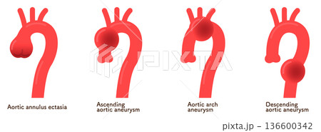 大動脈弁輪拡張症と大動脈瘤 annuloaortic ectasia&aortic aneurysm 136600342