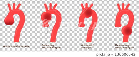 Aortic Annular Ectoses and Aortic Aneurysms 136600342