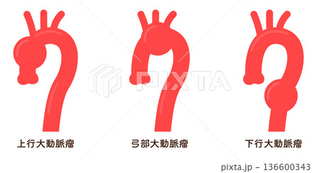大動脈瘤のイラスト　Illustration of an aortic aneurysm 136600343