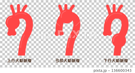 大動脈瘤のイラスト　Illustration of an aortic aneurysm 136600343