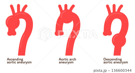 大動脈瘤のイラスト Illustration of an aortic aneurysm 大動脈瘤のイラスト Illustration of an aortic aneurysm 136600344