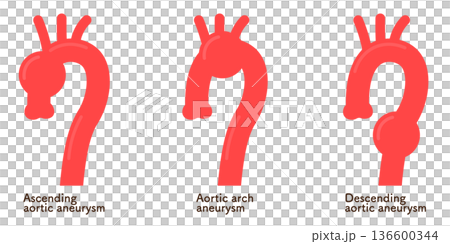 大動脈瘤のイラスト Illustration of an aortic aneurysm 大動脈瘤のイラスト Illustration of an aortic aneurysm 136600344