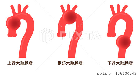大動脈瘤のイラスト Illustration of an aortic aneurysm 大動脈瘤のイラスト Illustration of an aortic aneurysm 136600345