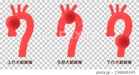 大動脈瘤のイラスト Illustration of an aortic aneurysm 大動脈瘤のイラスト Illustration of an aortic aneurysm 136600345