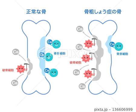 骨吸収と骨形成のしくみ　正常な骨と骨粗しょう症の骨 136606999