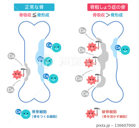 骨吸収と骨形成のしくみ　正常な骨と骨粗しょう症の骨 136607000