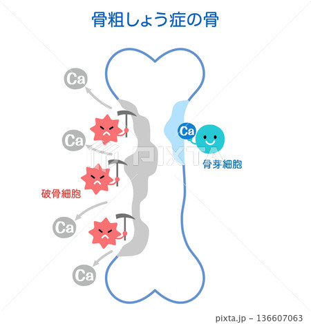骨吸収と骨形成のしくみ　骨粗しょう症の骨 136607063