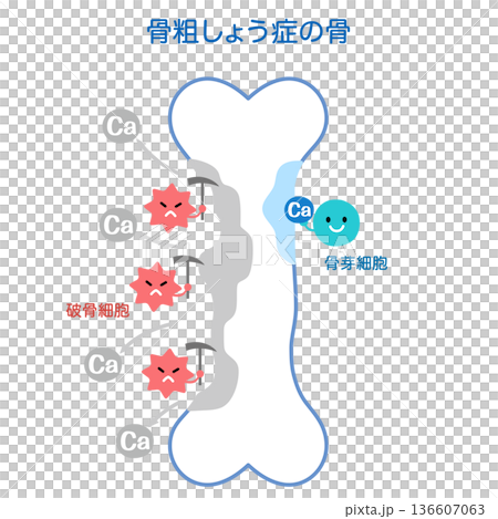 骨吸収と骨形成のしくみ　骨粗しょう症の骨 136607063