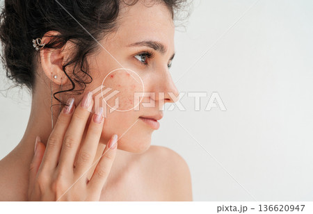 close-up portrait of young girl with pimples and acne on face on white isolated background. Female with problematic skin. Collage of bad unhealthy problem skin before and clean skin after treatment 136620947