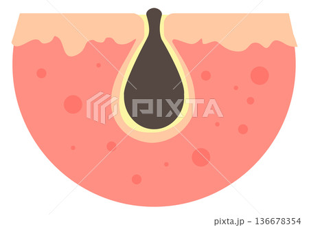 Clogged skin pore. Cartoon blackhead problem icon Clogged skin pore. Cartoon blackhead problem icon 136678354