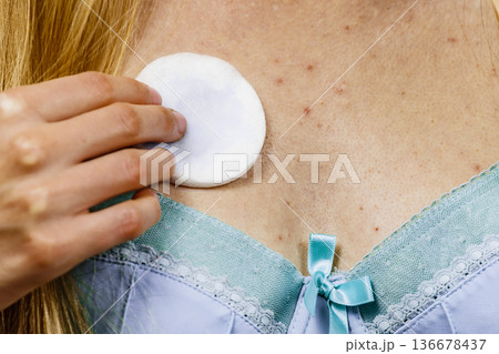 Woman acne on neckline cleaning skin with tonic Woman acne on neckline cleaning skin with tonic 136678437