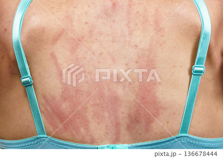 Woman scratching her itchy back with allergy rash Woman scratching her itchy back with allergy rash 136678444