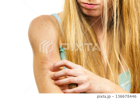 Woman scratching her itchy arm. Skin allergy. Woman scratching her itchy arm. Skin allergy. 136678446