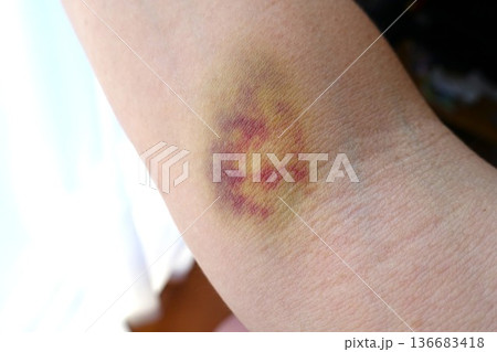 採血後の腕の内出血痕 136683418