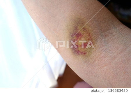 採血後の腕の内出血痕 136683420