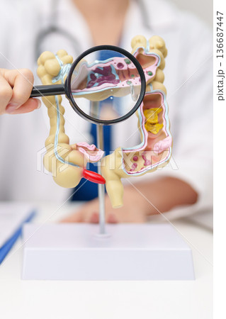 Doctor with human Colon anatomy model. Colonic disease, Large Intestine, Colorectal cancer, Ulcerative colitis, Diverticulitis, Irritable bowel syndrome, Digestive system and Healthcare concept Doctor with human Colon anatomy model. Colonic disease, Large Intestine, Colorectal cancer, Ulcerative colitis, Diverticulitis, Irritable bowel syndrome, Digestive system and Healthcare concept 136687447