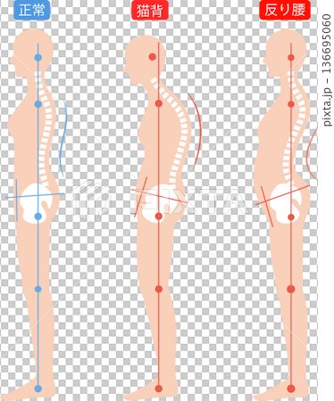 Correct posture and hunchback and arched back women's spine and pelvis 136695060