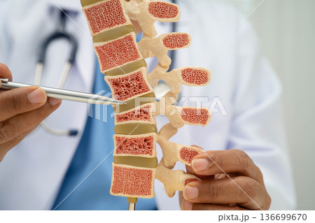 Doctor holding osteoporosis in back bone model for treatment medical in orthopedic department. Doctor holding osteoporosis in back bone model for treatment medical in orthopedic department. 136699670