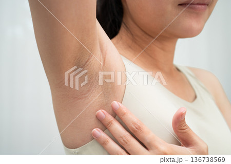 Asian woman have problem black armpit beauty skin care. 136738569