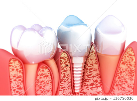 Tooth implant 136750030