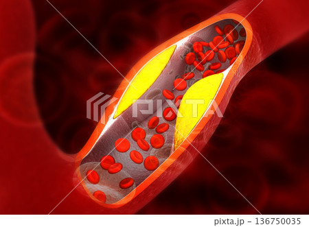 Cholesterol blocking artery Cholesterol blocking artery 136750035