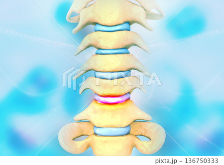 Disc problem of human spine 136750333