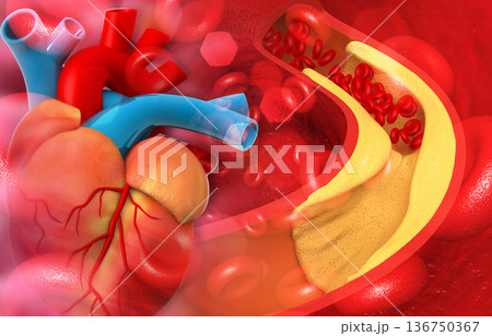 Human heart artery blocked with cholesterol Human heart artery blocked with cholesterol 136750367