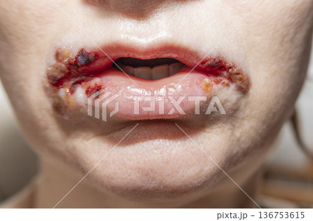 Staphylococcus infection on lips. Crack in the corner of the mouth, sores around the mouth, sore on the lips with dry blood on the woman face. 136753615