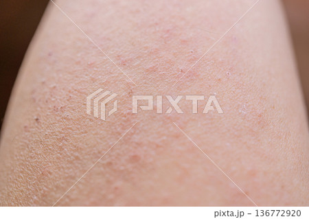 湿疹がでている女性の腕 皮膚 湿疹がでている女性の腕 皮膚 136772920