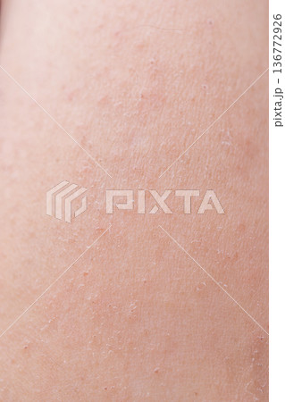 湿疹がでている女性の腕　皮膚 136772926