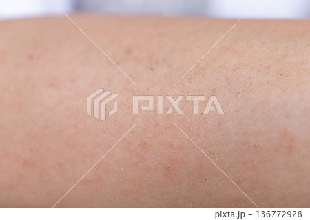 皮膚　かぶれ　湿疹　ただれ 136772928