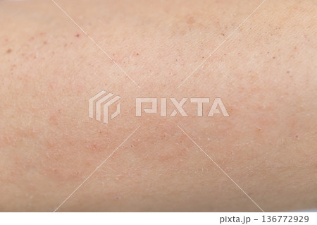 皮膚　かぶれ　湿疹　ただれ 136772929