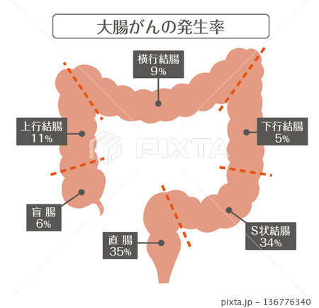大腸がんの発生率と部位別構造イラスト 136776340