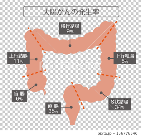 大腸がんの発生率と部位別構造イラスト 136776340