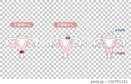 一幅醫學插圖，展示了子宮頸癌和子宮內膜癌的差異。 136791181