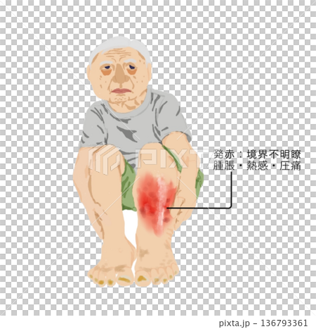 蜂窩織炎の症状イラスト 高齢者の下腿発赤・腫脹・熱感・圧痛の医療図解 蜂窩織炎の症状イラスト 高齢者の下腿発赤・腫脹・熱感・圧痛の医療図解 136793361
