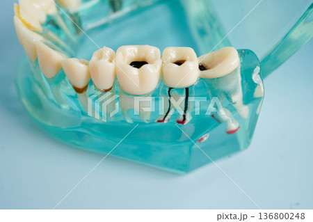 Dental implant, artificial tooth roots into jaw, root canal of dental treatment, gum disease, teeth model for dentist studying about dentistry. 136800248