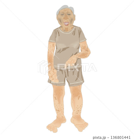 高齢者の脱水症状チェック｜全身所見と観察ポイントの医療イラスト 136801441