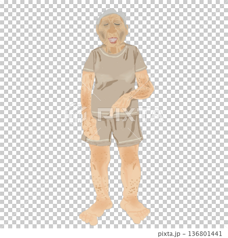 高齢者の脱水症状チェック｜全身所見と観察ポイントの医療イラスト 136801441