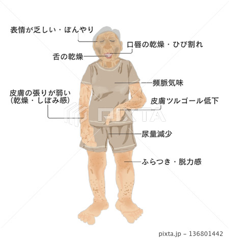 高齢者の脱水症状チェック|全身所見と観察ポイントの医療イラスト 高齢者の脱水症状チェック|全身所見と観察ポイントの医療イラスト 136801442